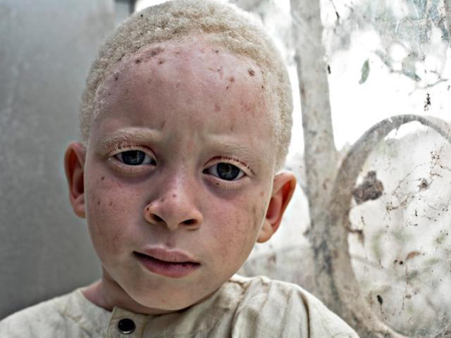 Casa África muestra la realidad de la vida de los albinos en Senegal con una exposición fotográfica