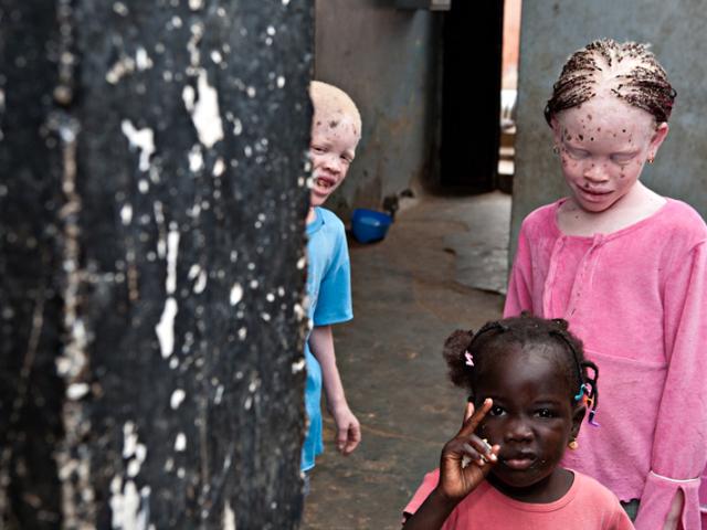 Casa África muestra la realidad de la vida de los albinos en Senegal con una exposición fotográfica